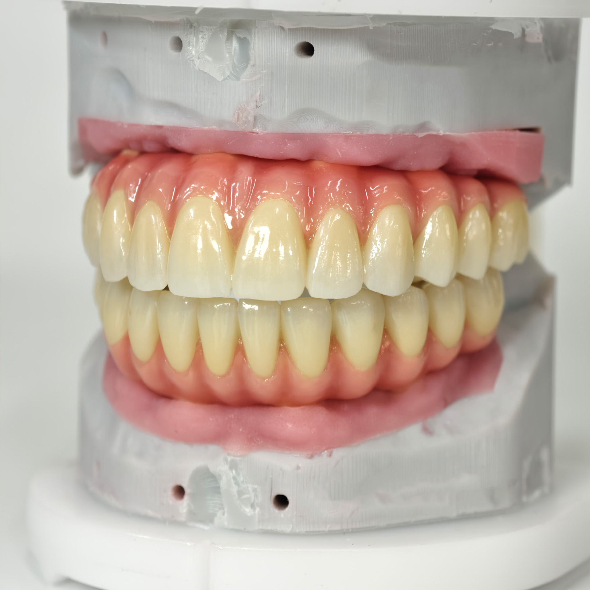 Zirconia-Enamel Hybrid Malo Bridge