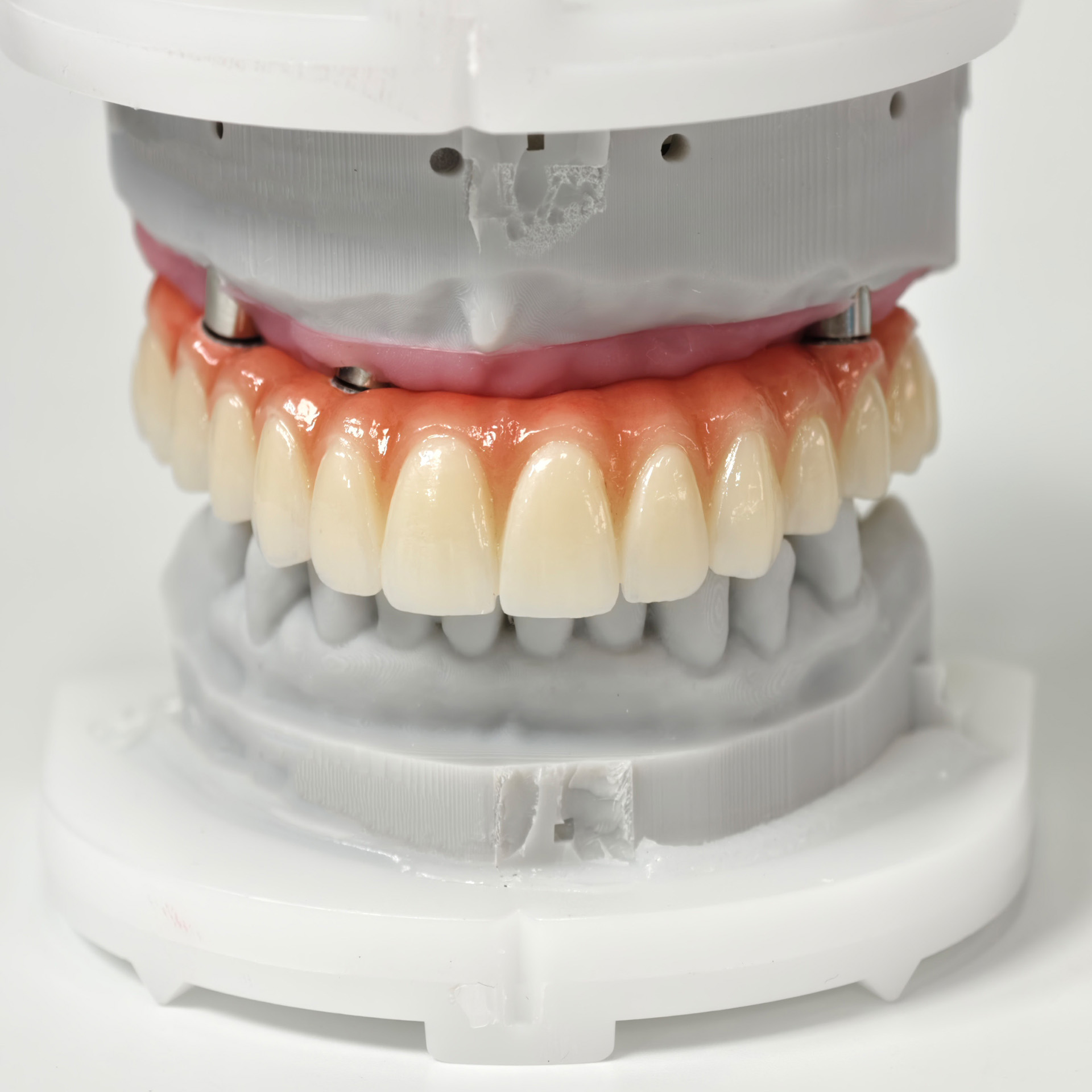 All on 5 zirconia bridge with Ti-base sc