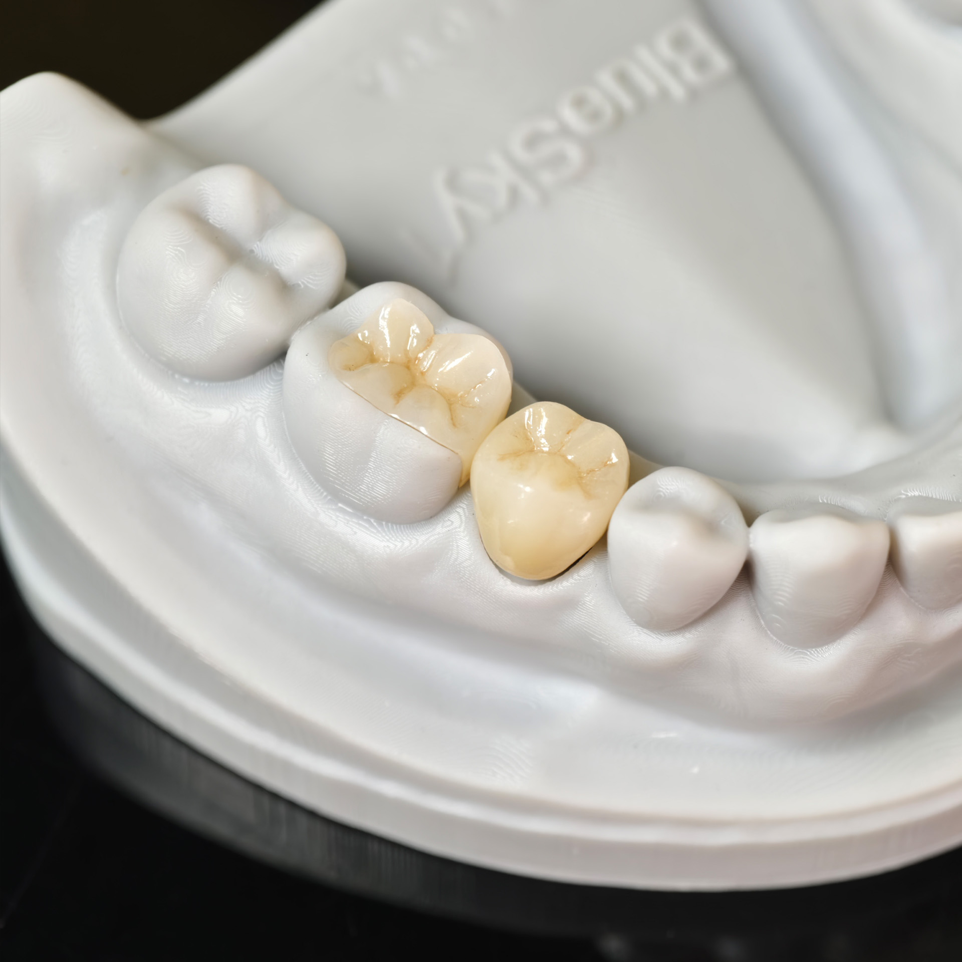 High - Strength Zirconia Inlay and Crown