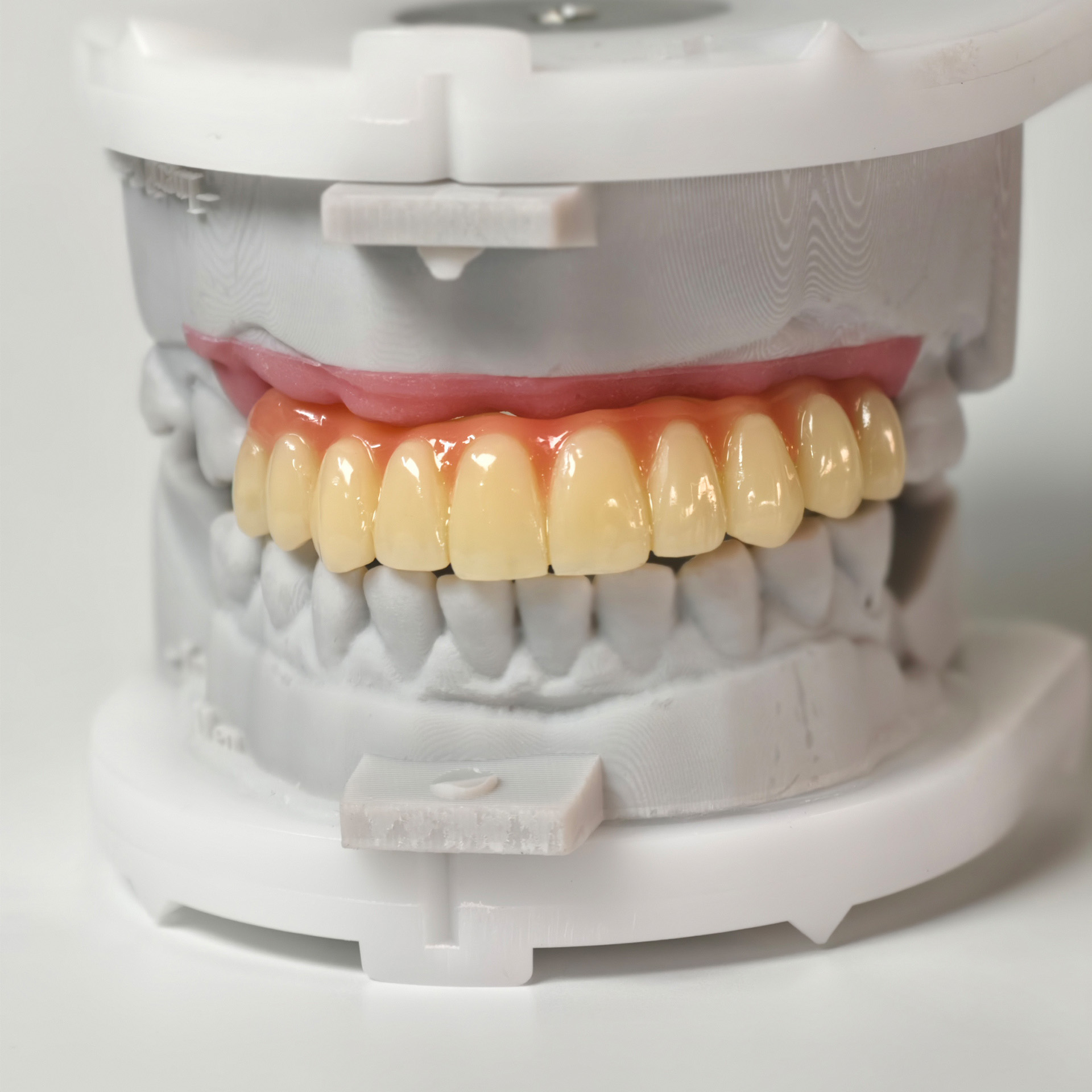 PMMA bridge with screw retained