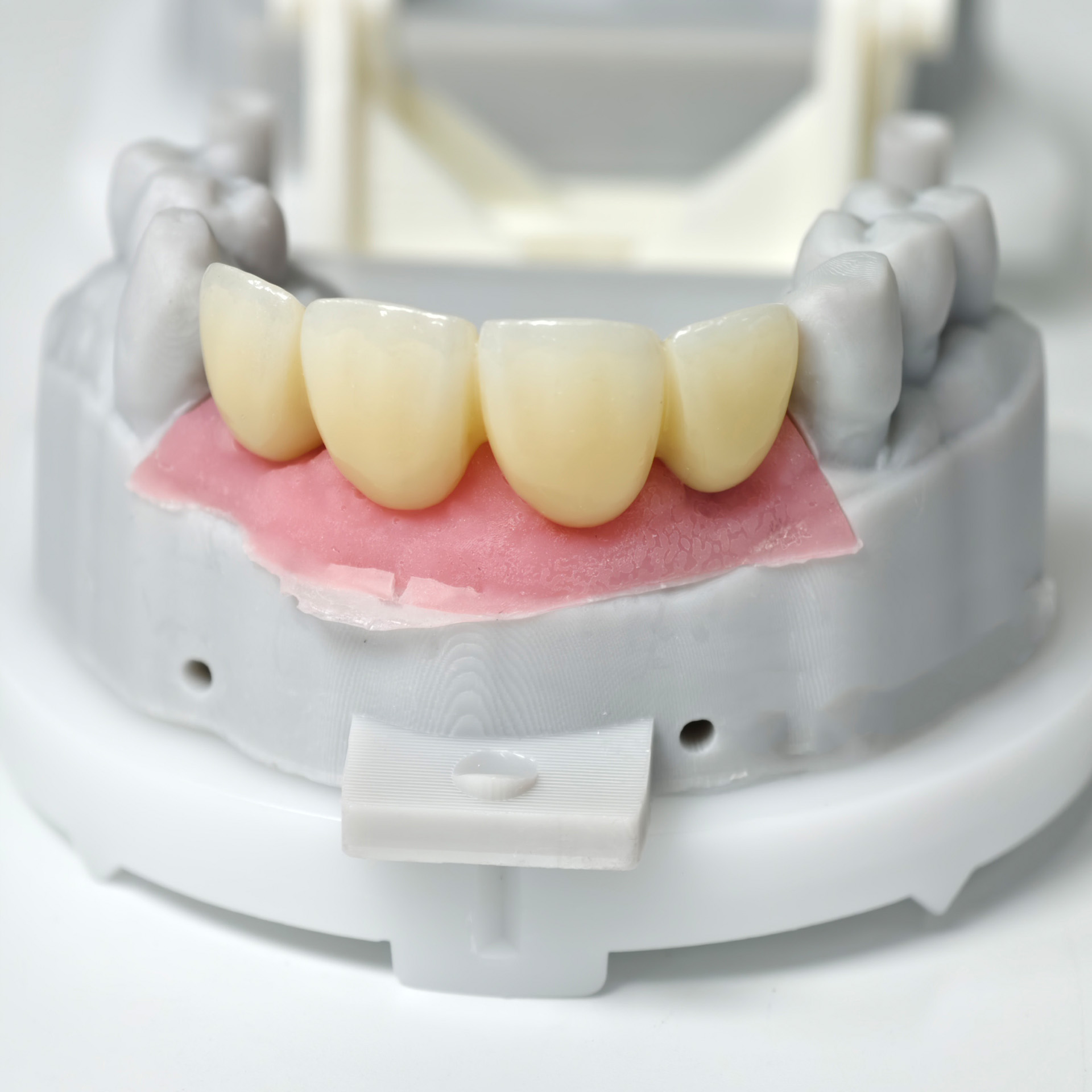 Zirconia bridge with screw retained