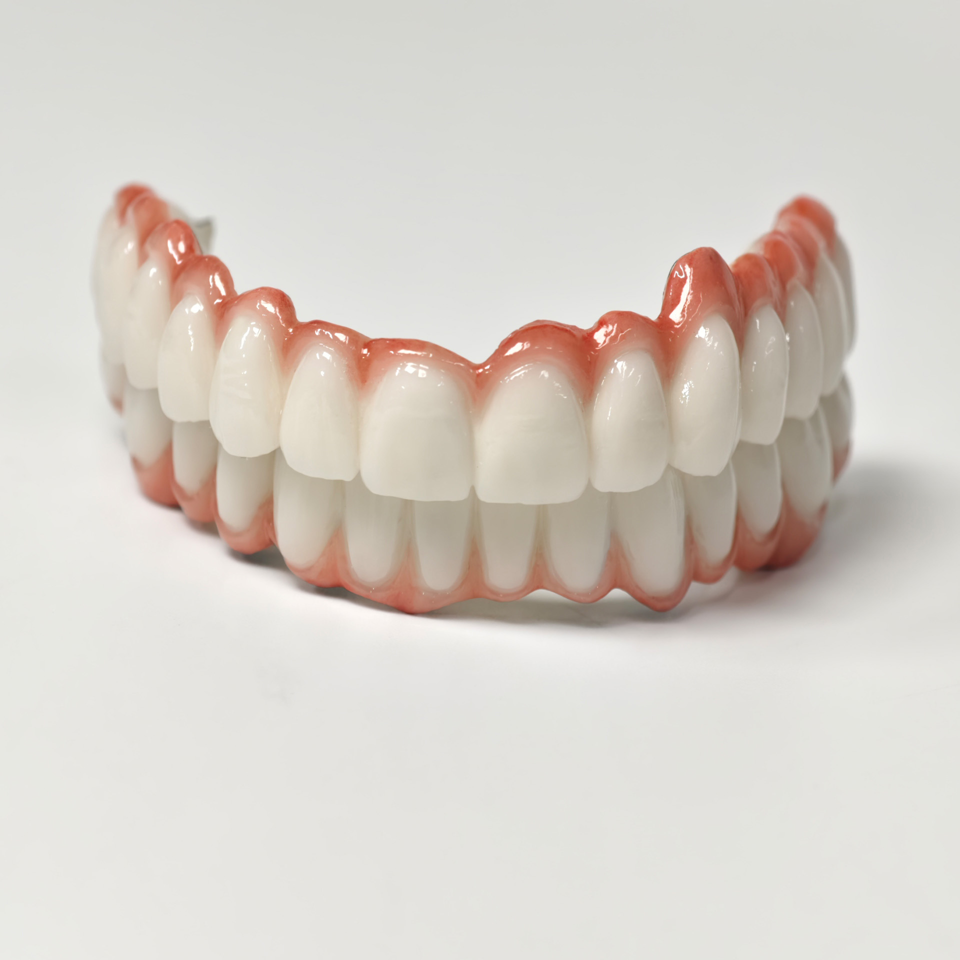 full-arch PFM bridge with screw retained